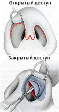 Ринопластика длинного носа